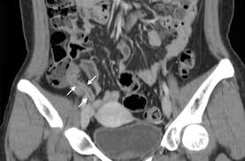 Acute appendicitis CT