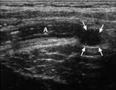 Appendiceal carcinoid