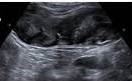Appendiceal mucocele