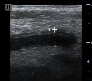 Acute appendicitis
