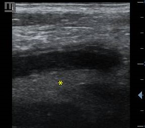 Periappendiceal fat inflammation in appendicitis