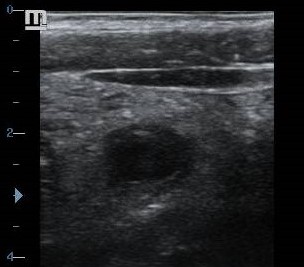Target sign in appendicitis ultrasound