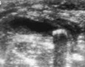 Appendicolith