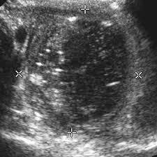 Appendiceal abscess