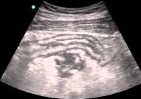 Perforated appendicitis
