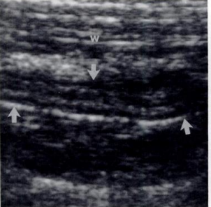 Chronic appendicitis