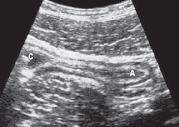 Normal appendix ultrasound