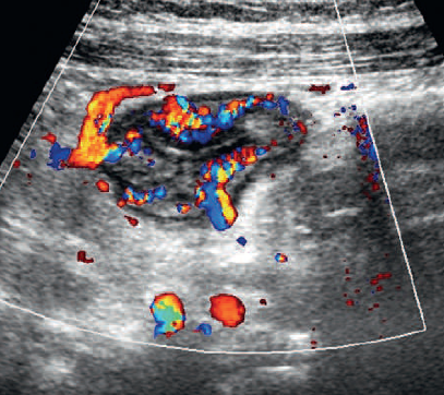 Inflammatory bowel