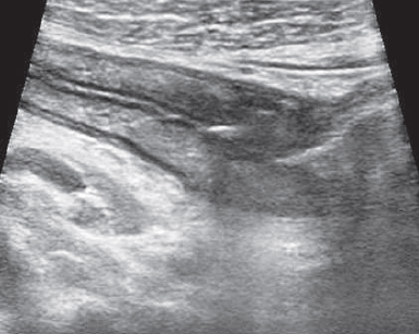 Crohn's disease