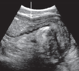 Fibrotic stricture