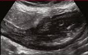 Crohn's stricture