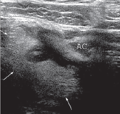 Diverticulitis