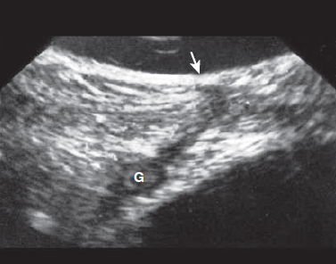 IBD fistula