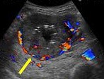 GIST tumor