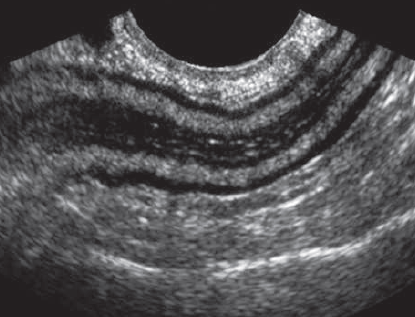 GI ultrasound