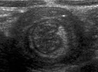 Intussusception