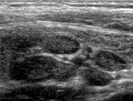 Mesenteric adenitis