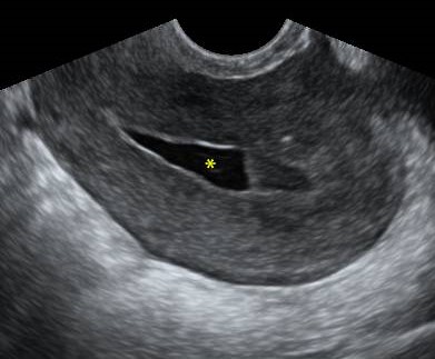 Endometritis
