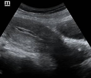 Endometritis with air