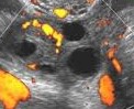Oophoritis hypervascularity