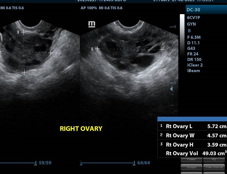 Oophoritis with stromal edema