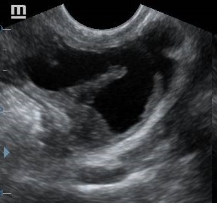 Acute salpingitis