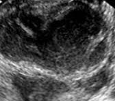 Tubo-ovarian abscess