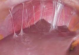 Violin string adhesions