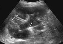 Pyelonephritis