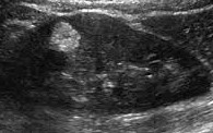 Angiomyolipoma