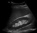 Normal kidney ultrasound