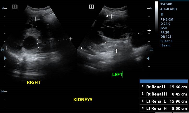 Enlarged kidneys with innumerable cysts of varying sizes