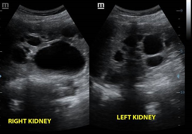 kidneys with cysts of varyying sizes and random distribution in the cortex and medullar