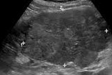 Renal cell carcinoma