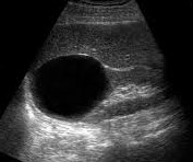 Renal cyst