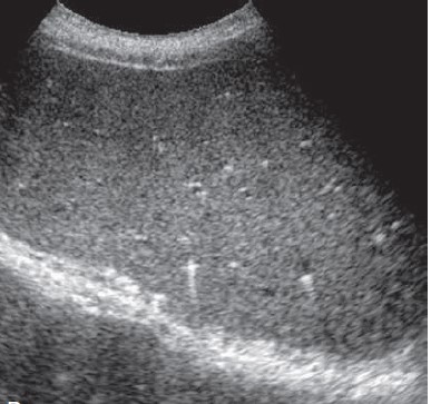 Image of the liver showing multiple echogenic foci with comet tail artifacts