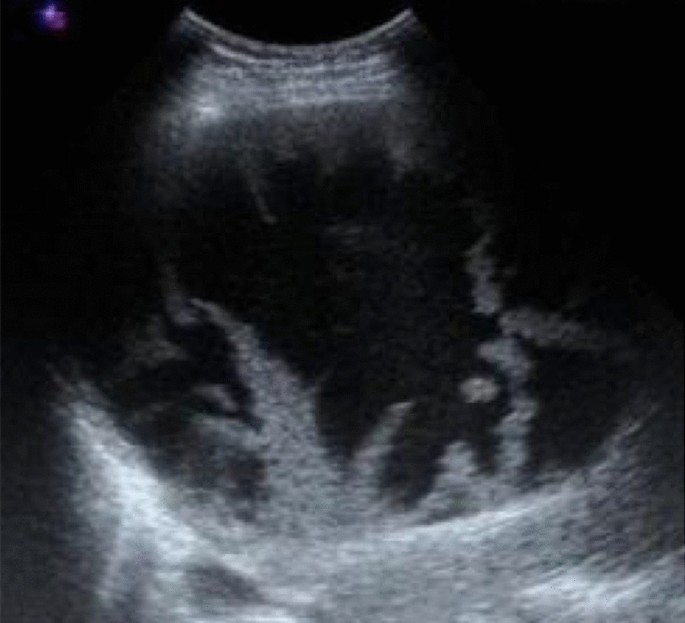 Complex hepatic cyst with thick septae