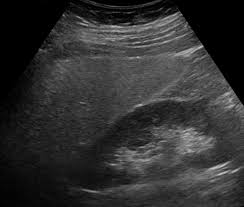 mild increase in liver echogenicity