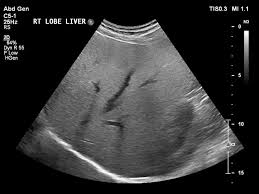 loss of visualization of portal vein walls