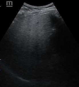 increased posterior attenuation