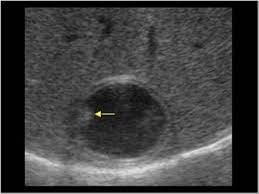 anechoic cyst with double wall