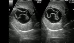 cyst with floating membranes