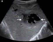 anechoic liver cystic mass with features suggesting an abscess