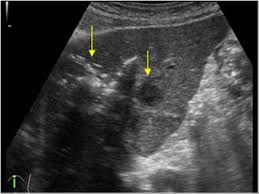 liver abscess with reverberation artifacts