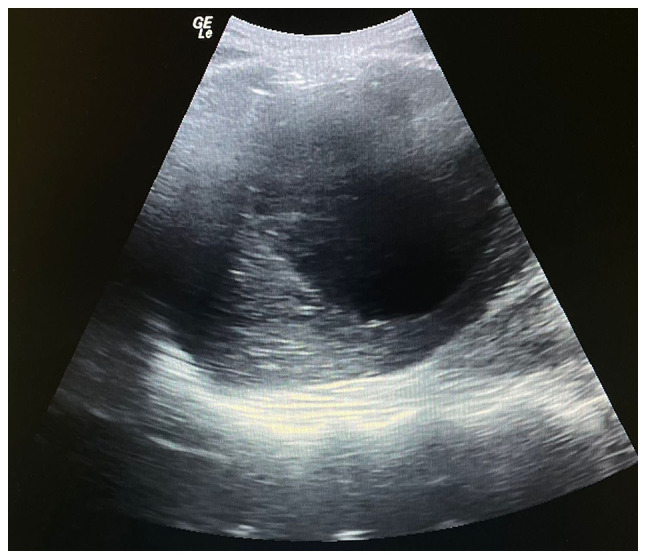 abscess with internal echoes