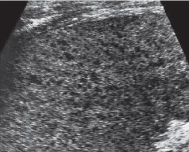 Uniformly hypoechoic pattern of liver parenchyma