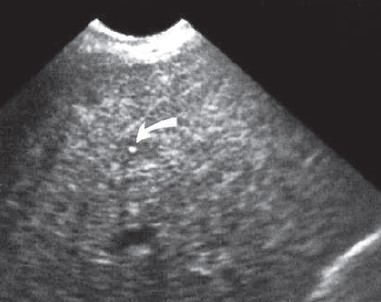 echogenic pattern after medical therapy