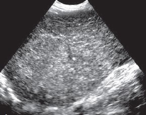 Liver with coarse echotexture