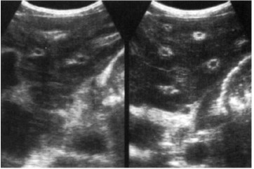 Periportal fibrosis due to s. mansoni