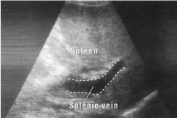 Splenic dilatation due hepatic schistosomiasis